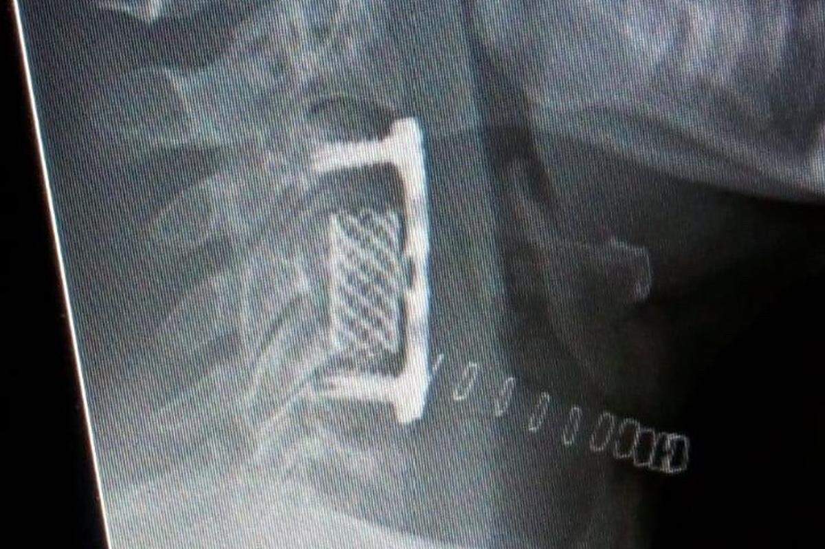 Alexander Austin is recovering from a broken neck suffered when he dove into shallow water on the Guatemalan coast on Jan. 2. This X-ray image of the titanium rods, titanium mesh cylinder and palladium plate implanted during surgery is on the gofundme page set up by friend Dillon Nicholson.