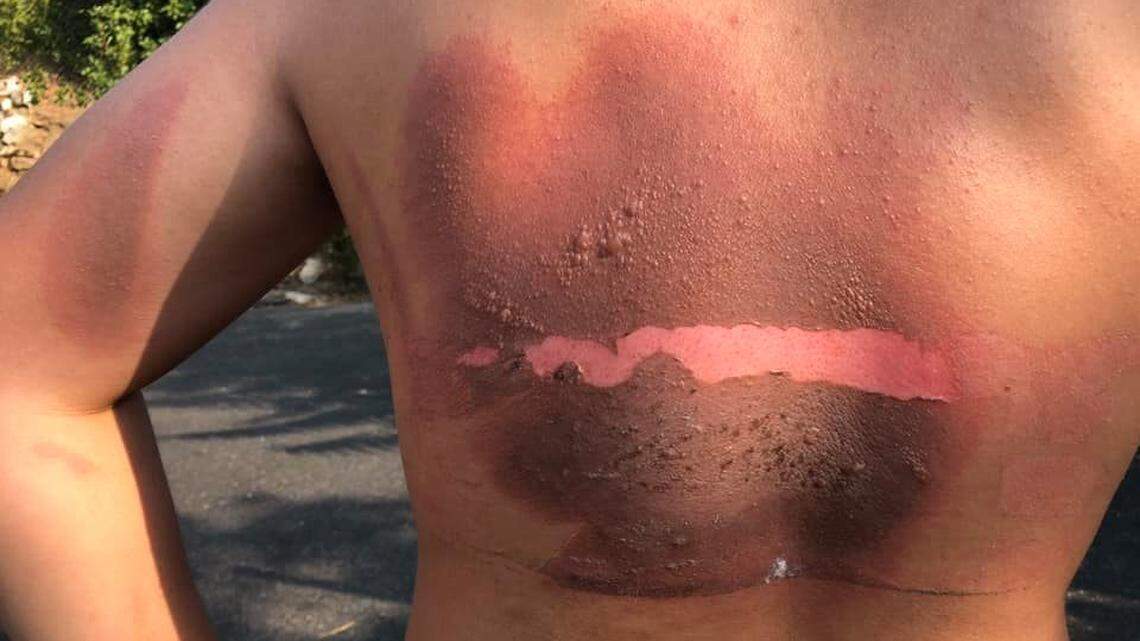 The skin of Tuolumne resident Colton Pingree’s back was blackened and blistered when a battery being recharged on his bed exploded during the night in mid-August 2020