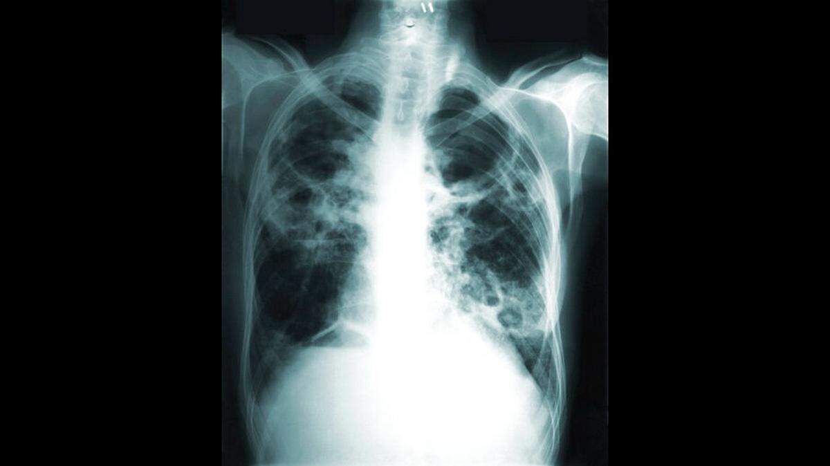 This image made available by the Centers of Disease Control and Prevention shows a chest X-ray of a tuberculosis patient.