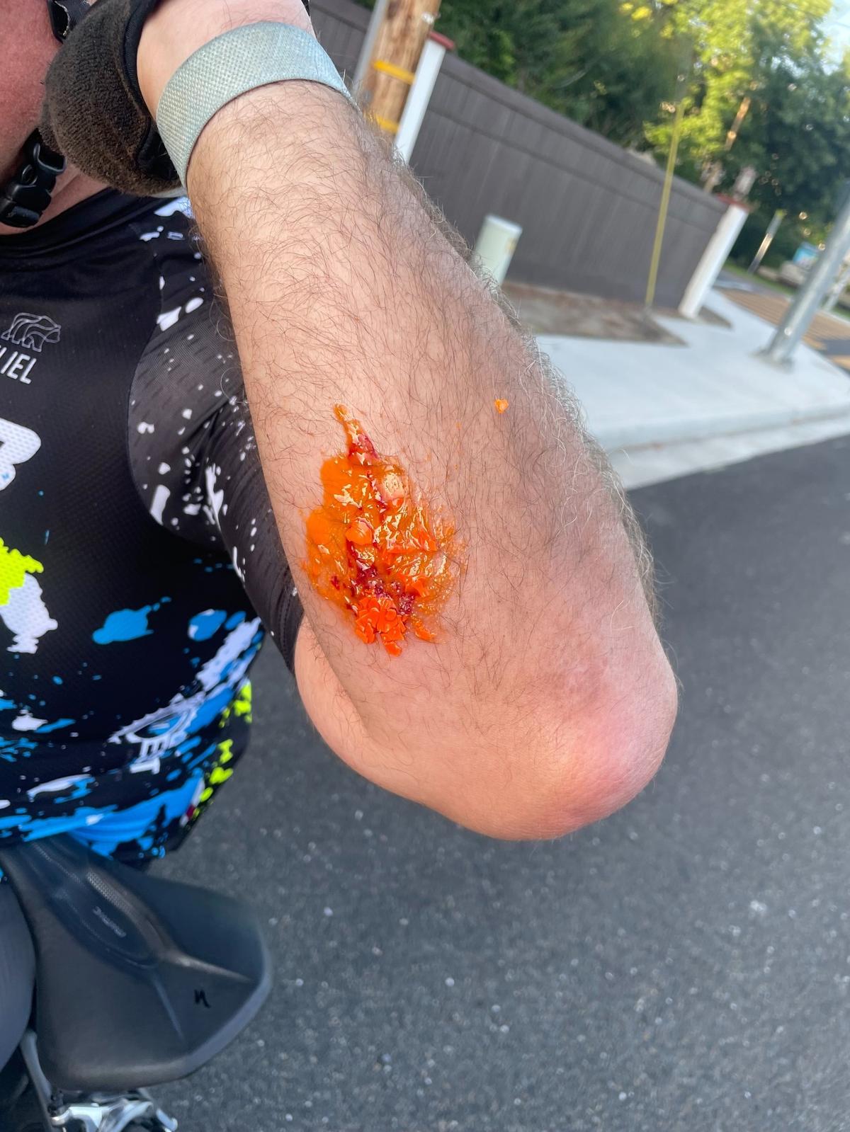 In this photo he shared on Facebook, Mitch Boehs shows where he was struck by a paintball fired at him Wednesday evening when he was biking in Turlock.