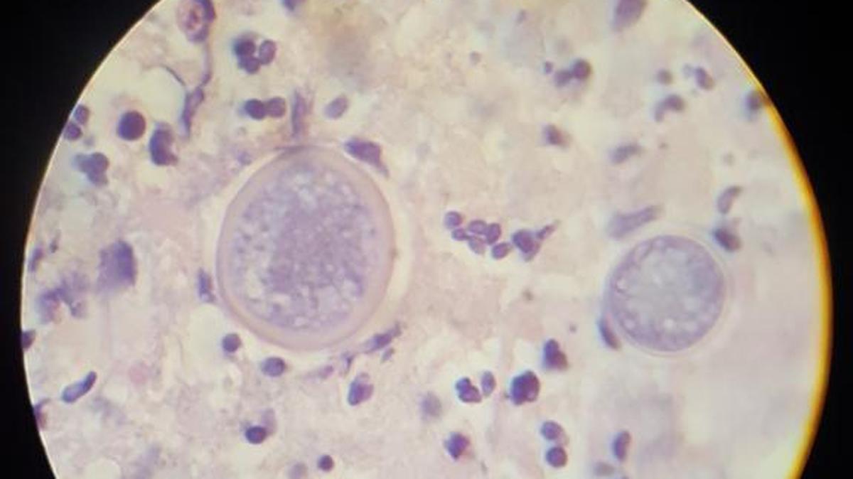 A sample of coccidioides spherules are pictured here in lung tissue. Coccidioidomycosis, also known as valley fever, is an infection caused by the fungus coccidioides. A sixth person died in San Luis Obispo County this year from valley fever.